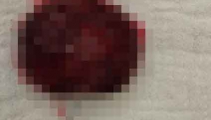Kontrolleri aksattı kalbinde portakal büyüklüğünde tümör çıktı